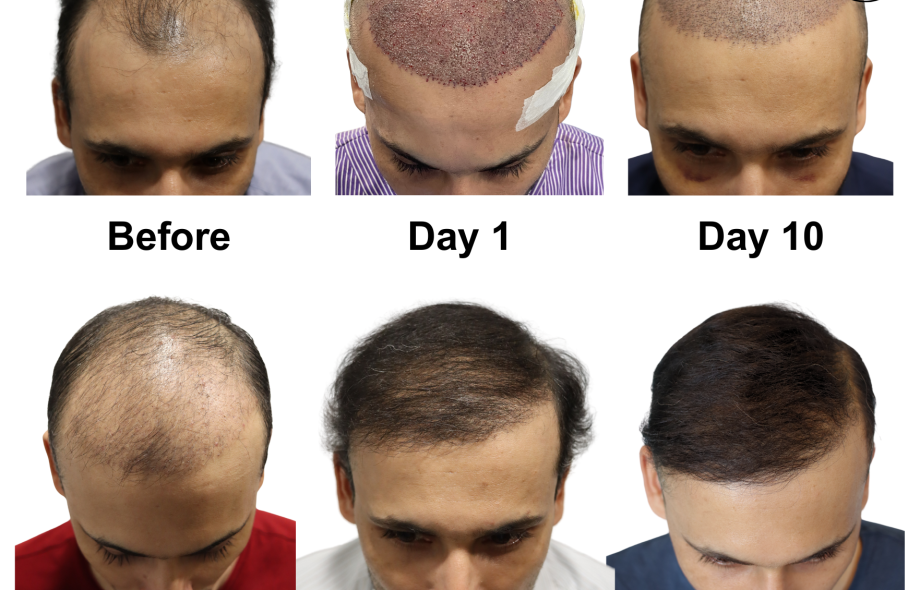 best hair transplant in Ahmedabad