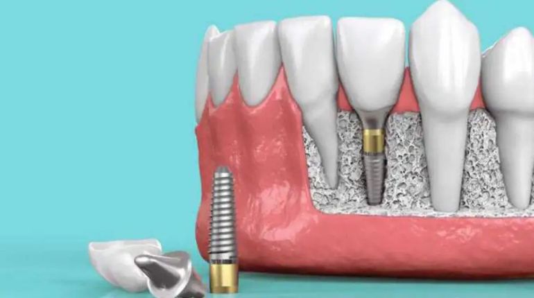 Dental Implants Cost in ahmedabad