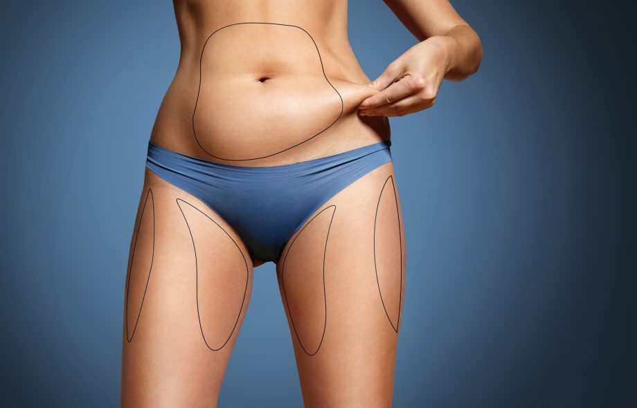 BodyTite Liposuction Riyadh